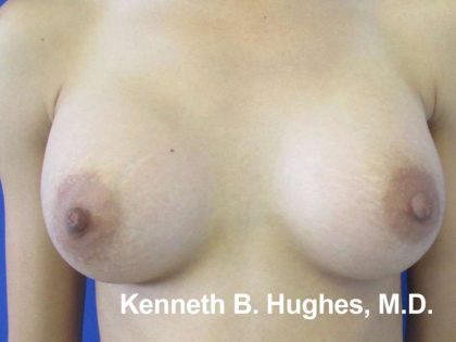 Breast Augmentation Implants Before & After Patient #7350