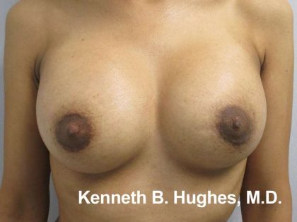 Breast Augmentation Implants Before & After Patient #7353