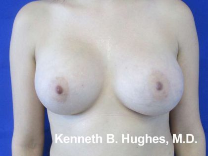 Breast Augmentation Implants Before & After Patient #7356