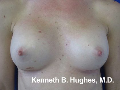 Breast Augmentation Implants Before & After Patient #7359