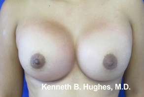 Breast Augmentation Implants Before & After Patient #7362