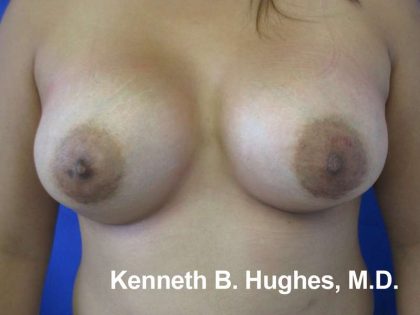 Breast Augmentation Implants Before & After Patient #7371