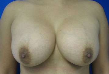 Breast Augmentation Implants Before & After Patient #7374