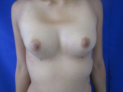 Breast Augmentation Implants Before & After Patient #7377