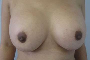 Breast Augmentation Implants Before & After Patient #7386