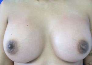 Breast Augmentation Implants Before & After Patient #7389