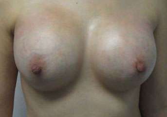 Breast Augmentation Implants Before & After Patient #7392