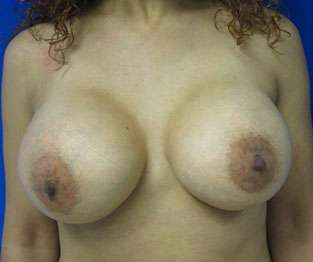 Breast Augmentation Implants Before & After Patient #7398