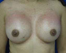 Breast Augmentation Implants Before & After Patient #7401