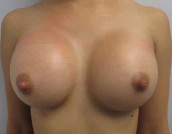 Breast Augmentation Implants Before & After Patient #7407