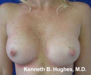 Breast Augmentation Implants Before & After Patient #7410