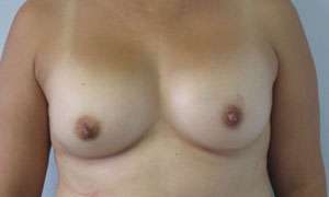 Breast Augmentation Implants Before & After Patient #7422
