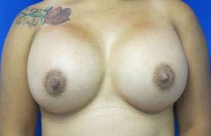 Breast Augmentation Implants Before & After Patient #7434