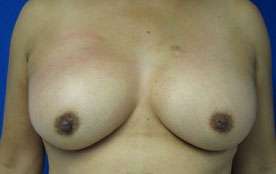 Breast Augmentation Implants Before & After Patient #7443
