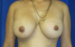 Breast Augmentation Implants Before & After Patient #7452