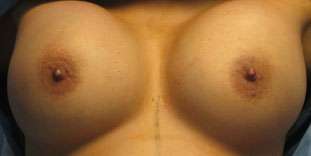 Breast Augmentation Implants Before & After Patient #7458