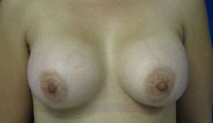 Breast Augmentation Implants Before & After Patient #7467
