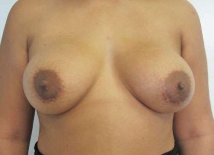 Breast Augmentation Implants Before & After Patient #7470