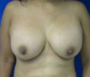 Breast Augmentation Implants Before & After Patient #7473