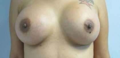 Breast Augmentation Implants Before & After Patient #7497