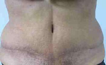 Body Lift Before & After Patient #6020