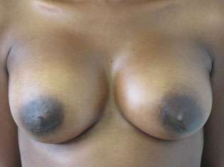 Breast Augmentation Implants Before & After Patient #7512