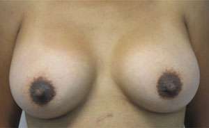 Breast Augmentation Implants Before & After Patient #7518