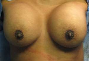 Breast Augmentation Implants Before & After Patient #7533
