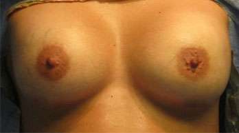 Breast Augmentation Implants Before & After Patient #7551