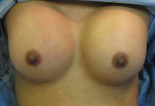 Breast Augmentation Implants Before & After Patient #7557