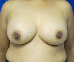 Breast Augmentation Implants Before & After Patient #7560