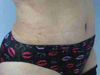 Body Lift Before & After Patient #6026