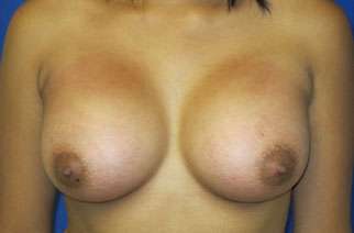 Breast Augmentation Implants Before & After Patient #7566
