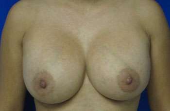 Breast Augmentation Implants Before & After Patient #7572