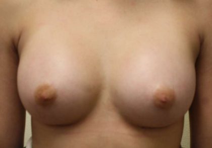 Breast Augmentation Implants Before & After Patient #7578