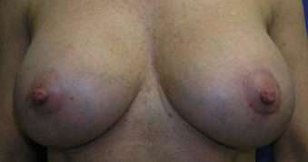 Breast Augmentation Implants Before & After Patient #7586