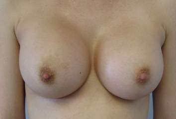Breast Augmentation Implants Before & After Patient #7589