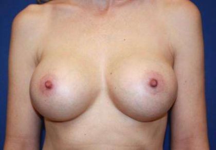 Breast Augmentation Implants Before & After Patient #7592