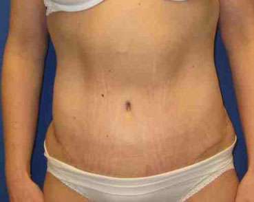 Body Lift Before & After Patient #6029