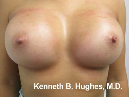 Breast Augmentation Implants Before & After Patient #7604