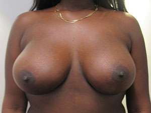 Breast Augmentation Implants Before & After Patient #7611