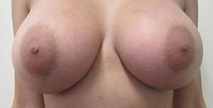 Breast Augmentation Implants Before & After Patient #7618