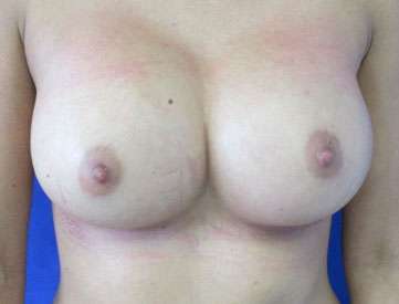 Breast Augmentation Implants Before & After Patient #7621
