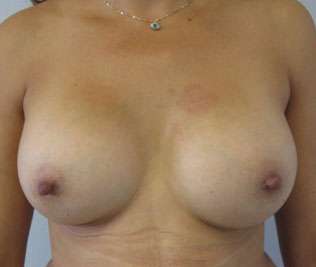 Breast Augmentation Implants Before & After Patient #7624