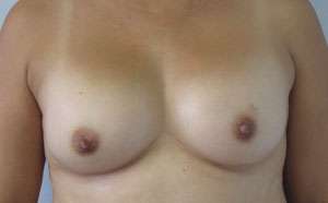 Breast Augmentation Revision Before & After Patient #7633