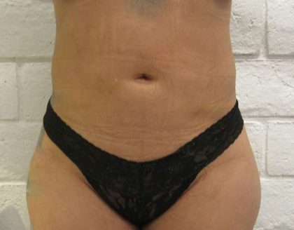 Bodytite Before & After Patient #6032