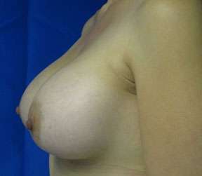 Breast Augmentation Revision Before & After Patient #7636