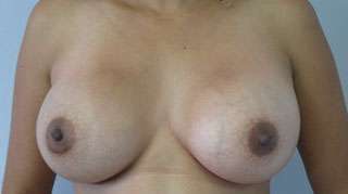 Breast Augmentation Revision Before & After Patient #7639