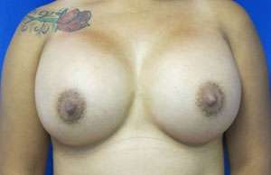 Breast Augmentation Revision Before & After Patient #7645