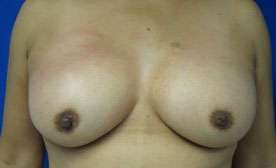 Breast Augmentation Revision Before & After Patient #7654